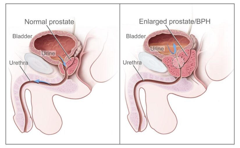 Normal and abornmal prostate. National Institutes of Health